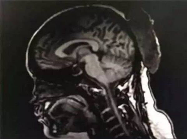 后怕！小伙擠個痘痘，擠出高燒、眼睛肺部嚴(yán)重感染送進(jìn)醫(yī)院…你可能也經(jīng)常這樣做