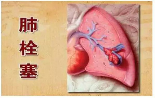 99%的血栓無(wú)征兆！記住一個(gè)字，讓你遠(yuǎn)離這個(gè)游走血管的幽靈