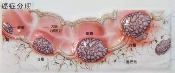 23歲女孩查出大腸癌！醫生說年輕腸癌患者基本都愛吃這個……