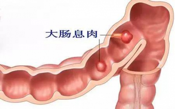體檢中發(fā)現(xiàn)胃腸息肉怎么辦，切還是不切？九成腸癌由息肉轉變而來
